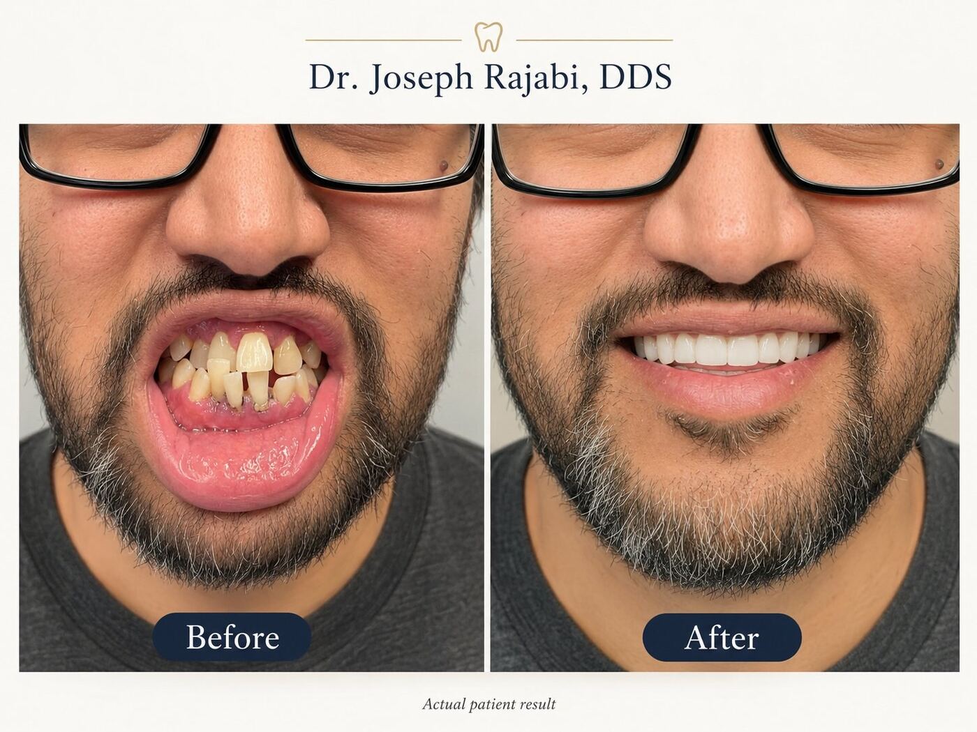Before and after smile transformation by Dr. Joseph Rajabi, DDS — actual patient result