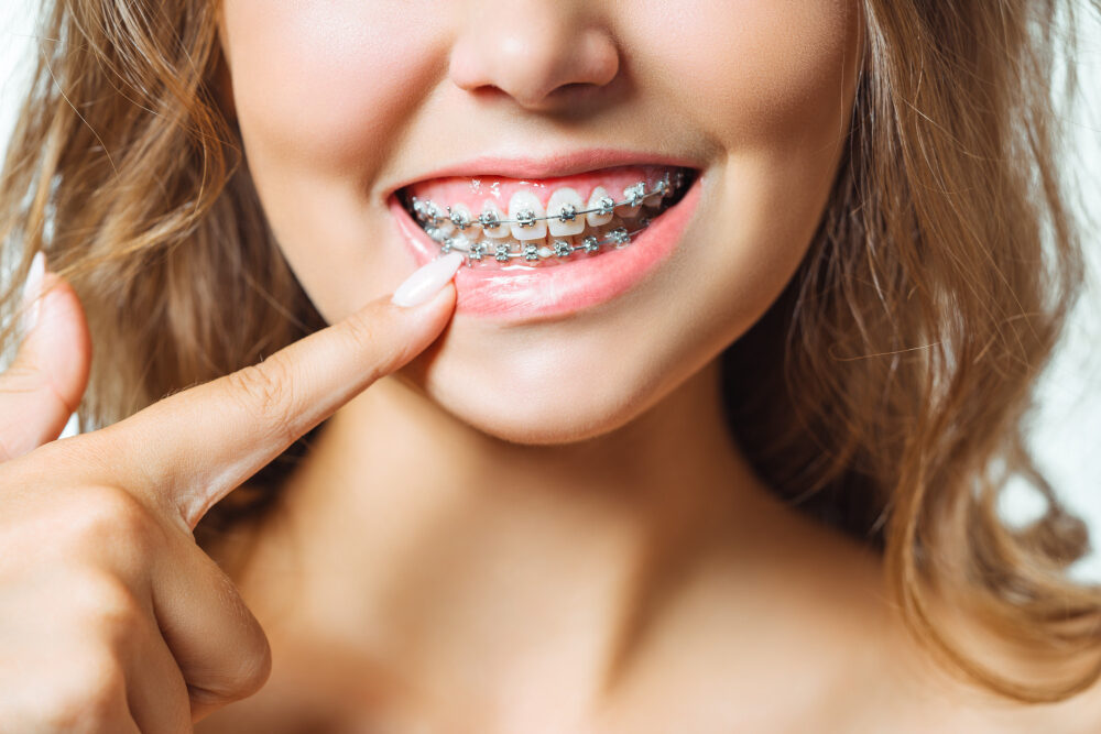 Conventional Braces in Corona, CA