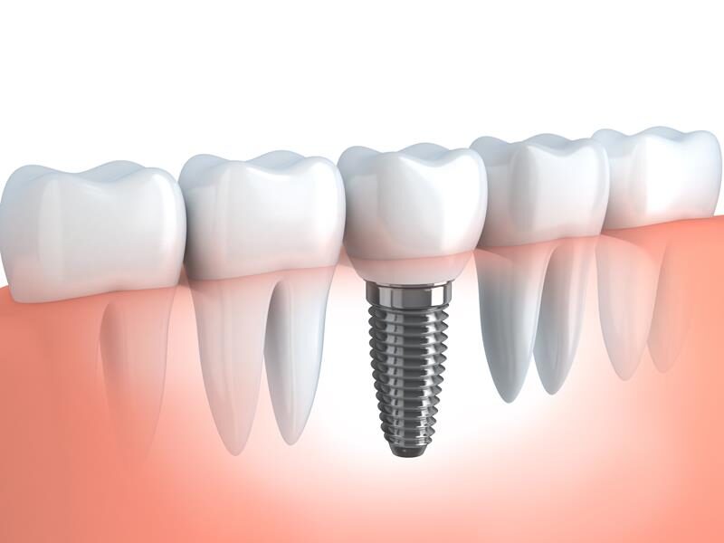 Dental Implants in Corona, CA