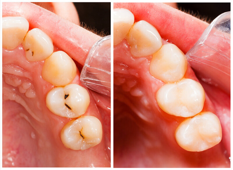 Fillings in Corona, CA