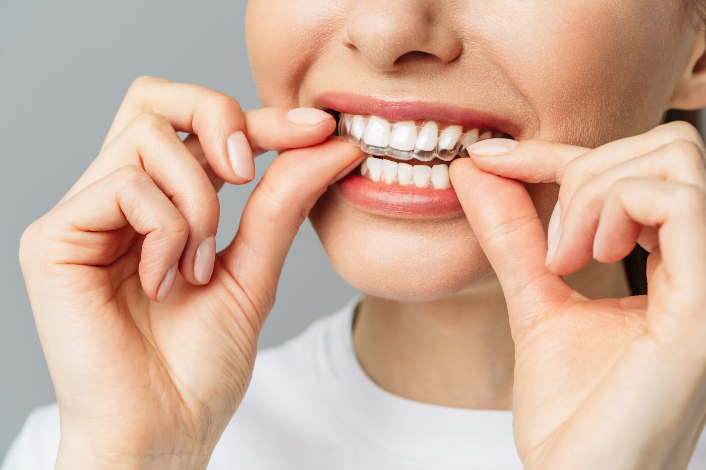 Invisalign in Corona, CA