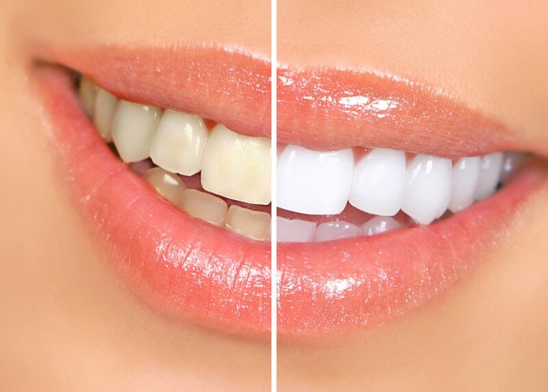 Teeth Whitening in Corona, CA
