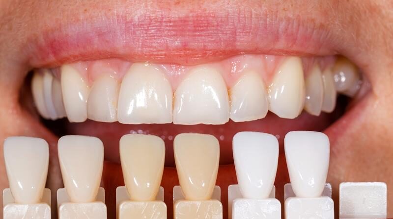 Veneers in Corona, CA